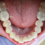 before clear correct 2