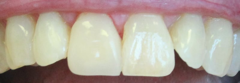 after cerec