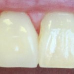 after cerec