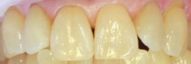 before cerec
