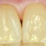 before cerec