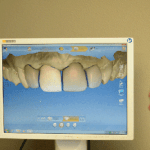 cerec image